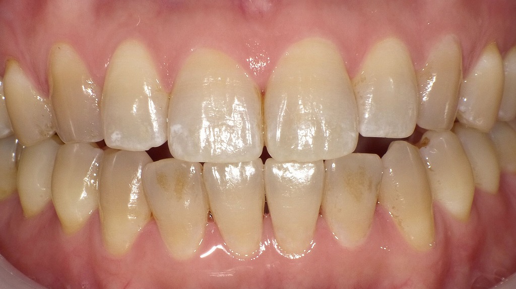 歯ぐきを守る第一歩｜定期的なクリーニング前の口腔内状態