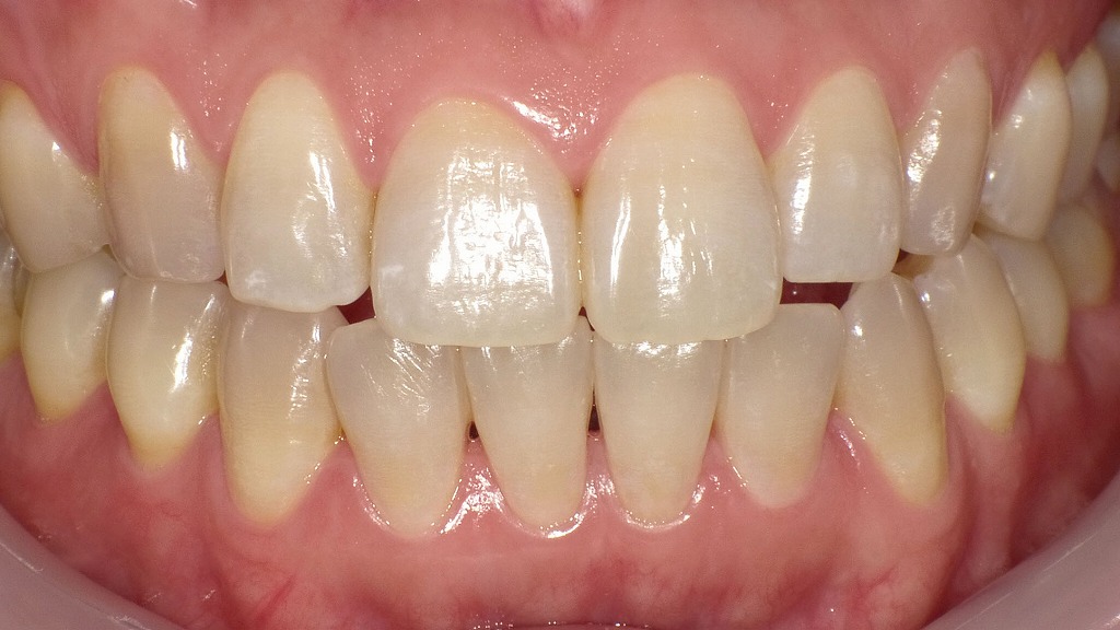 歯ぐきを強くする習慣｜定期クリーニング後の健康的な口腔内