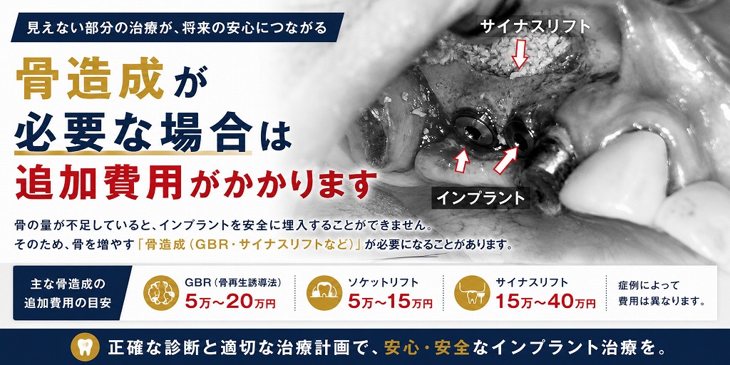 骨造成が必要な場合は追加費用がかかる