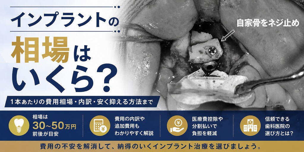 インプラントの相場はいくら？