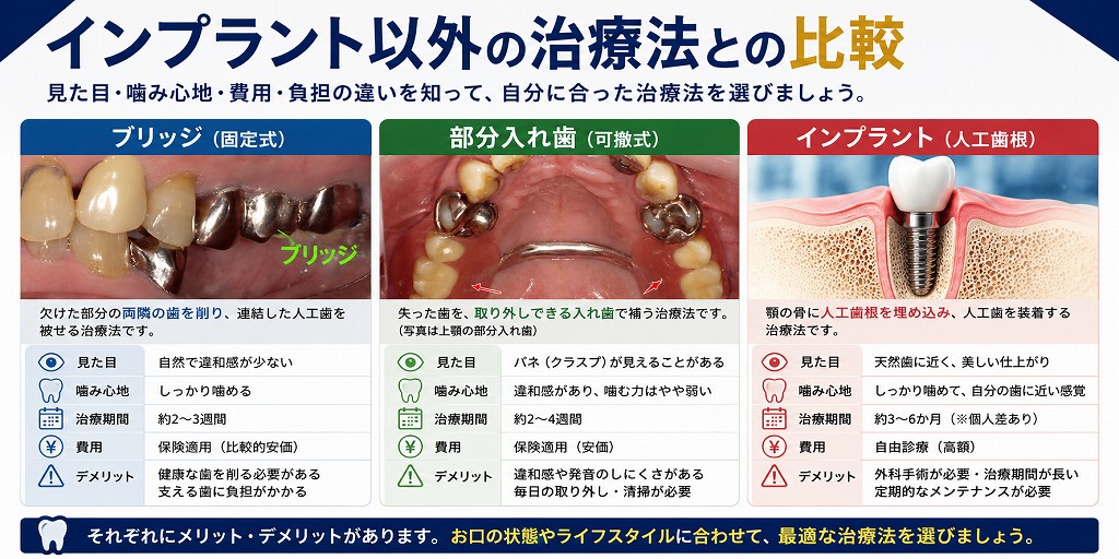 インプラント以外の治療法との比較