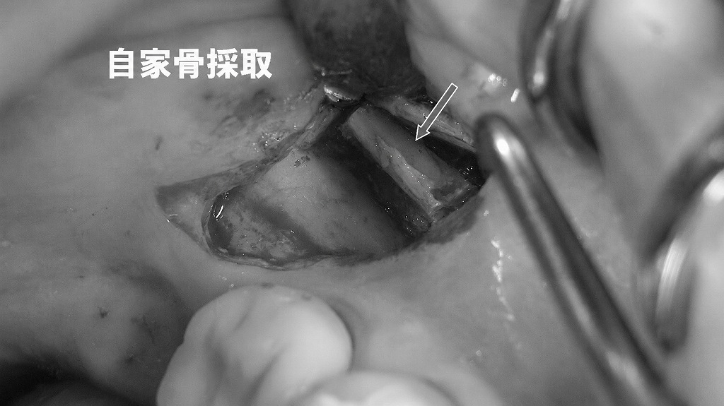 下顎7番遠心頬側からの自家骨採取