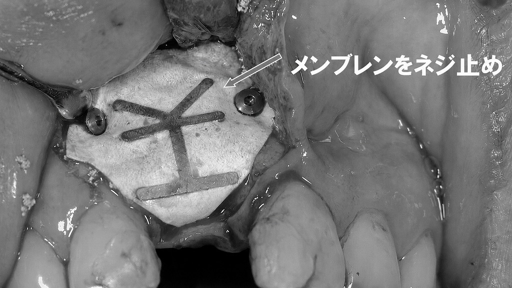 メンブレン固定によるGBR：骨造成部を確実に保護するステップ