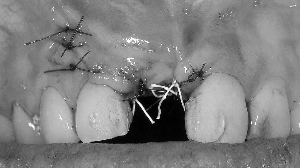 GBR後の創部を丁寧に縫合：骨造成を守る最終ステップ