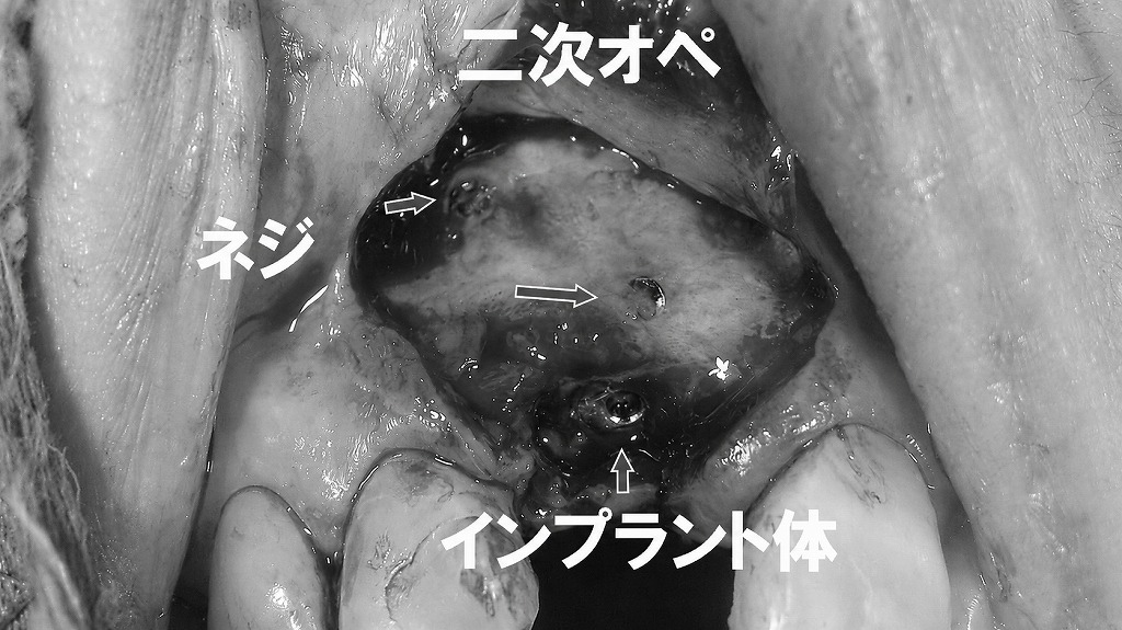 インプラント二次オペ：骨造成固定ネジを除去するステップ