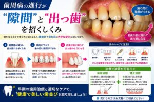 歯周病の進行が「隙間」と「出っ歯」を招く