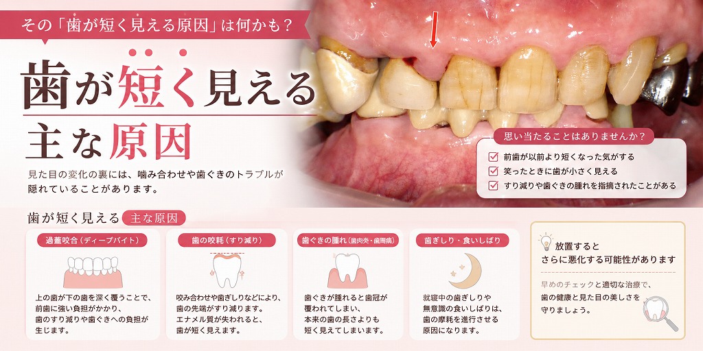歯が短く見える主な原因