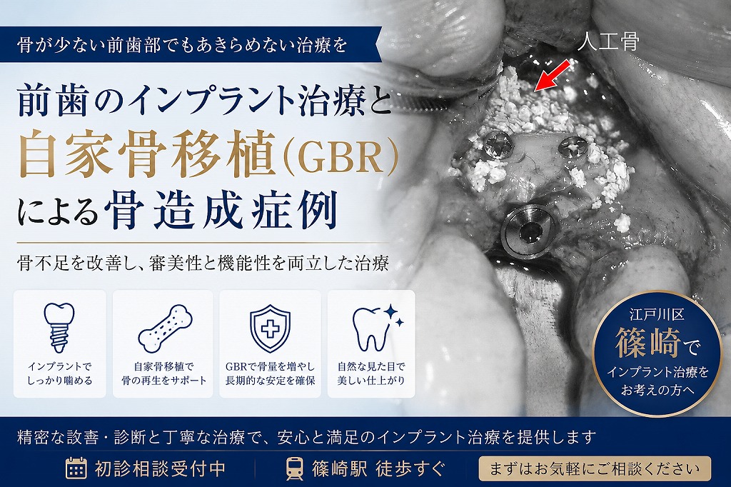 骨造成（GBR）を併用した上顎前歯部インプラント治療症例
