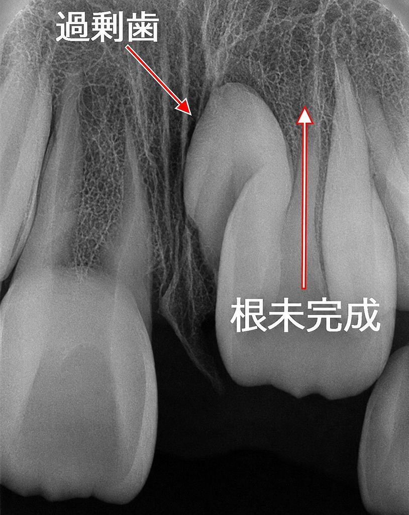 6歳児の完全埋伏逆性過剰歯レントゲン画像