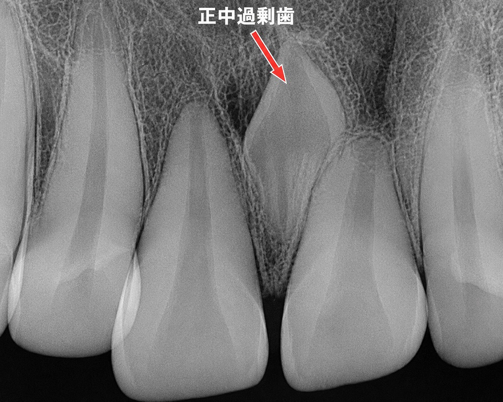 正中過剰歯の存在を確認：将来の歯並びを守るための抜歯が必要なケース