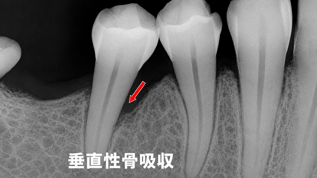 GTR法が適応となる垂直性骨欠損の一例