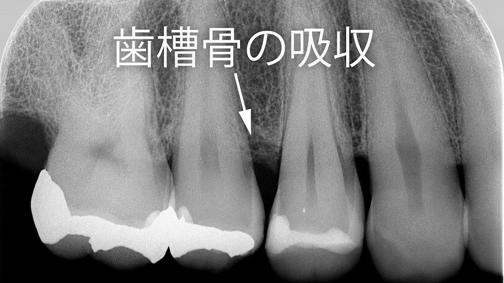 歯肉増殖部位のレントゲン所見