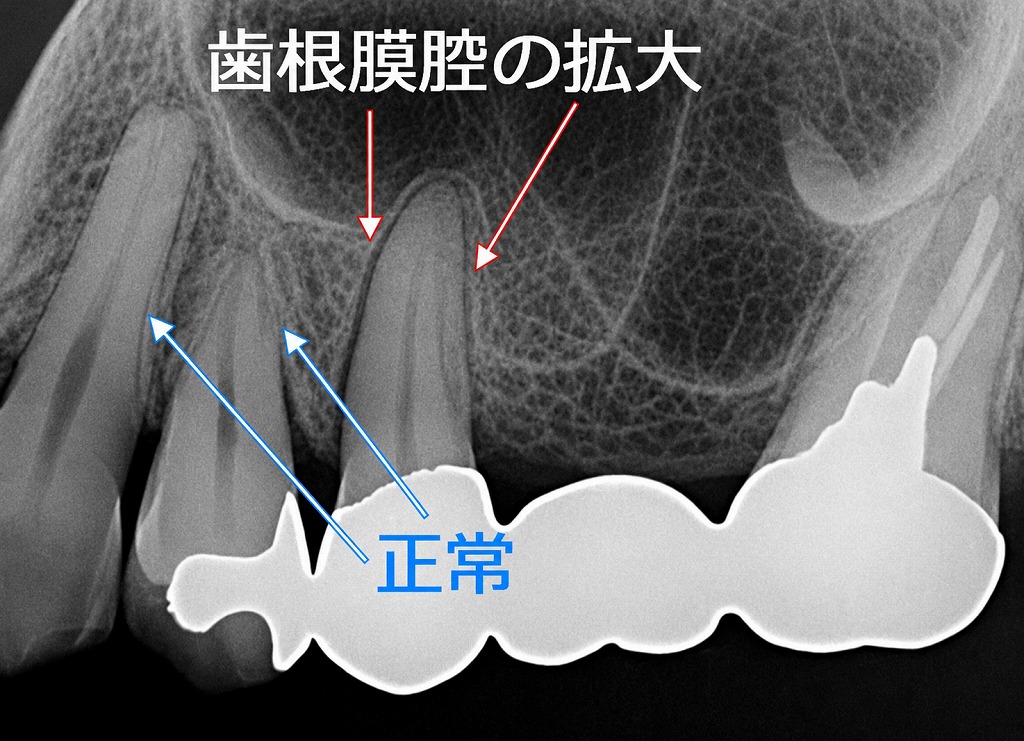 咬合性外傷による歯根膜の拡大