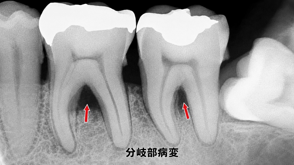 分岐部Ⅲ度病変：GTR法が適応できない進行した骨欠損