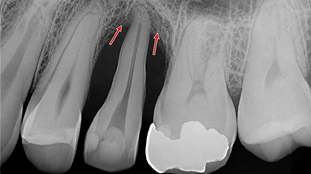 歯周病により歯がグラグラする：歯槽骨が溶けている