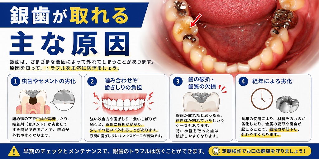 銀歯が取れる主な原因