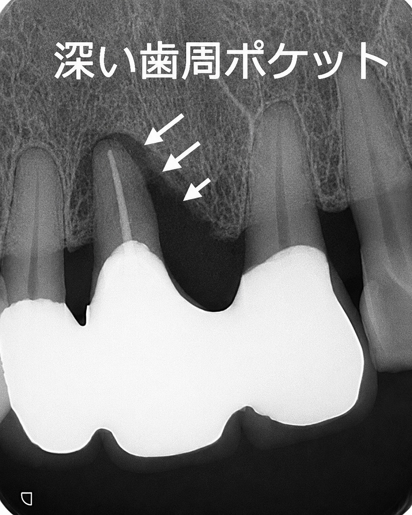 上顎一番近心に垂直性骨吸収