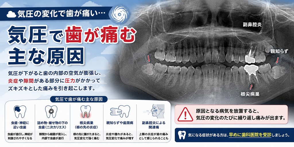気圧で歯が痛む主な原因