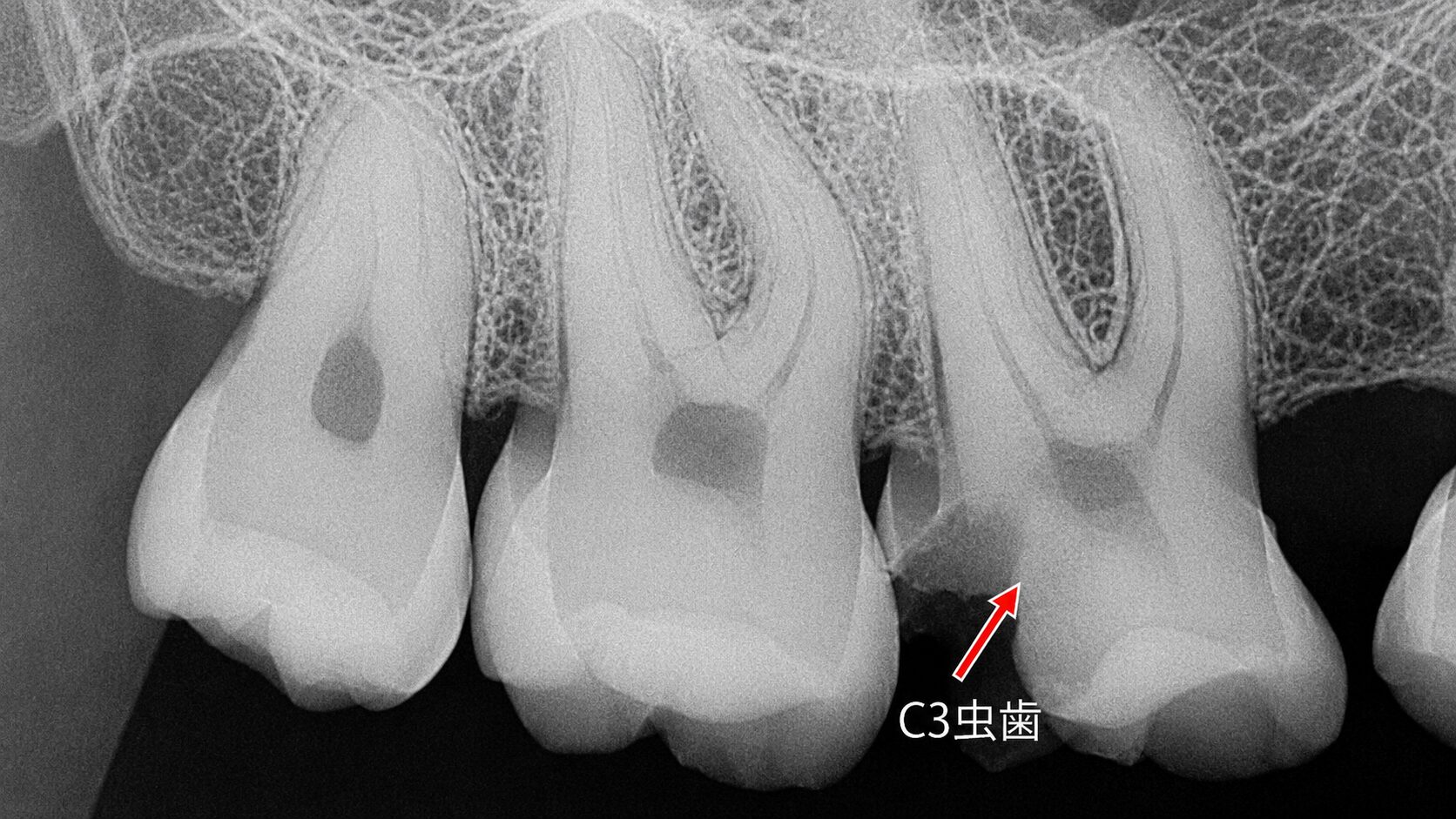 冷たいものがしみる原因 ― C3虫歯による神経への影響