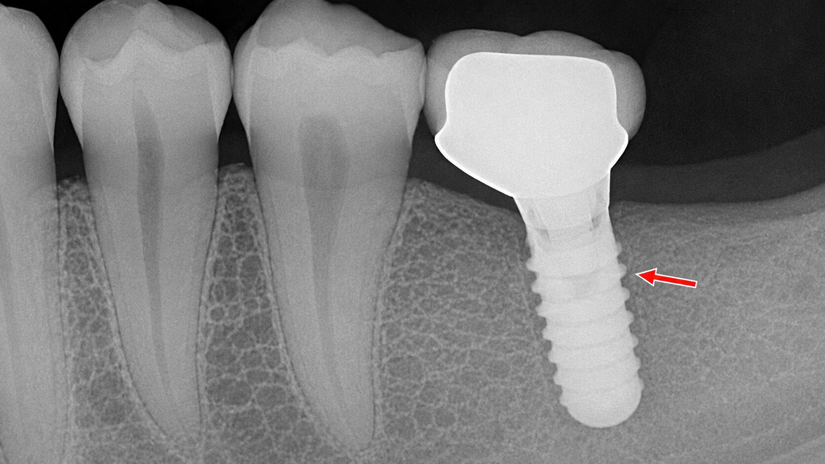 口腔機能低下症へのアプローチ ― インプラントによる噛む力の回復