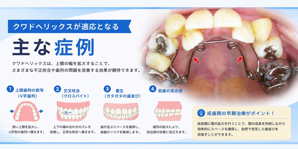 クワドヘリックスが適応となる主な症例