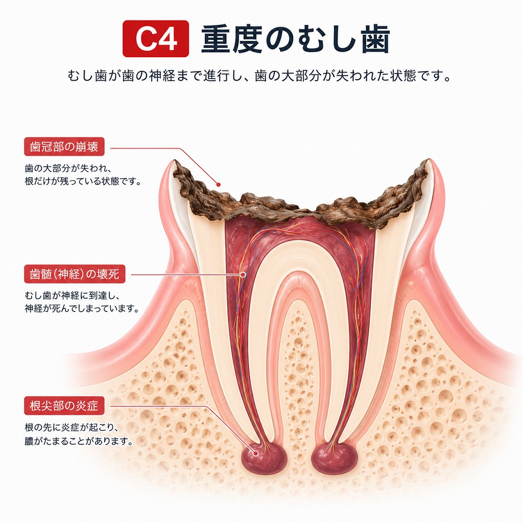 虫歯の進行度合いC4の模式図