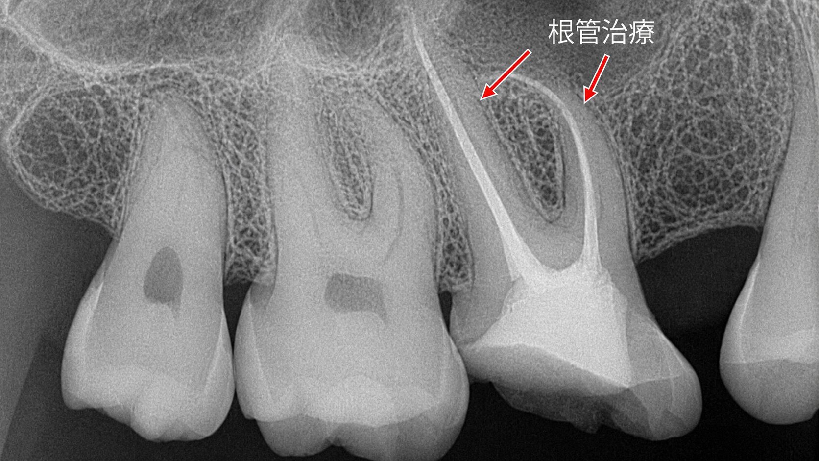 神経を取る治療 ― 根管治療後のレントゲン像