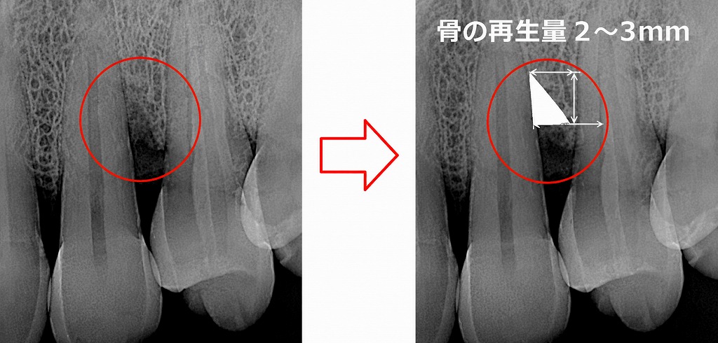 再生療法の有効性：2〜3mmの歯槽骨再生