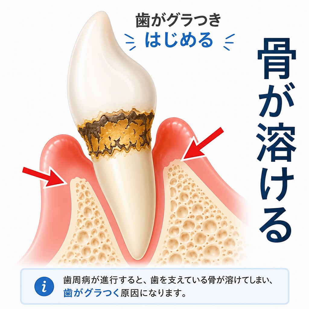 歯周病で歯がグラグラする