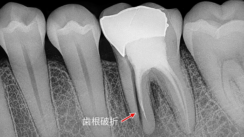 歯根破折
