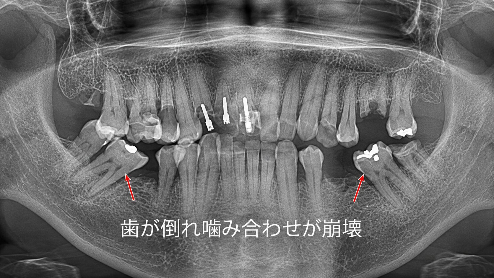 奥歯の虫歯を放置すると起こる「歯の傾斜」と噛み合わせの崩壊