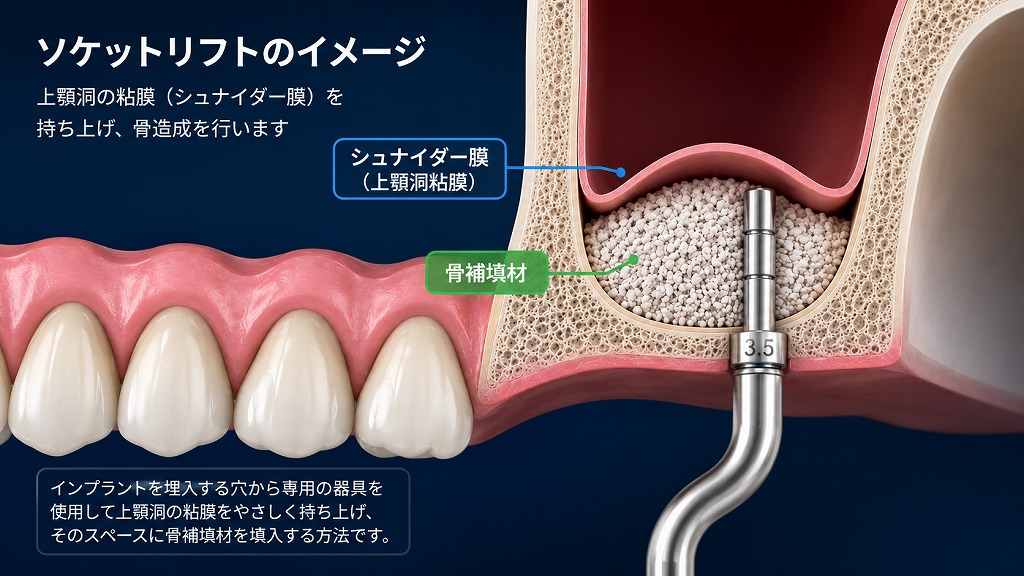 ソケットリフトとは？上顎の骨が足りなくてもインプラントが可能になる