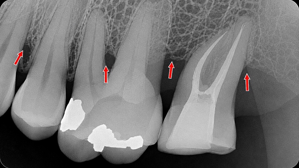 重度歯周病で歯石が多量に付着。1〜2ヶ月ごとの定期除去が必要