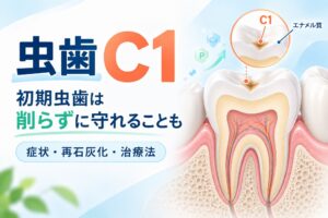 虫歯C1とは?削らずに治せる?症状・再石灰化・治療法を解説