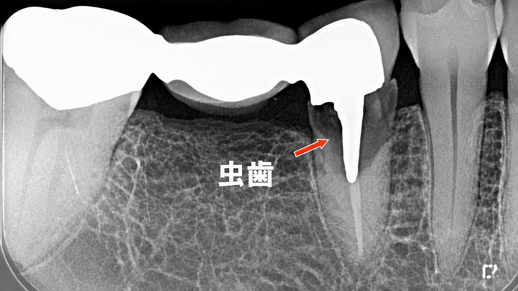下顎の5番・6番・7番にかけて装着されたブリッジ（銀歯）の下で虫歯が再発