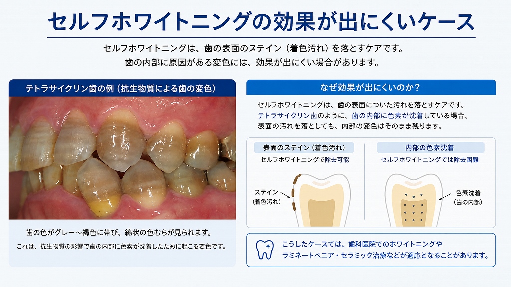 セルフホワイトニングの効果が出にくいケース