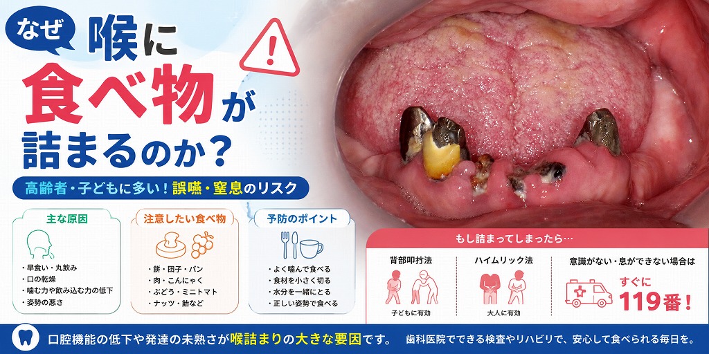 喉に食べ物が詰まる原因とは？