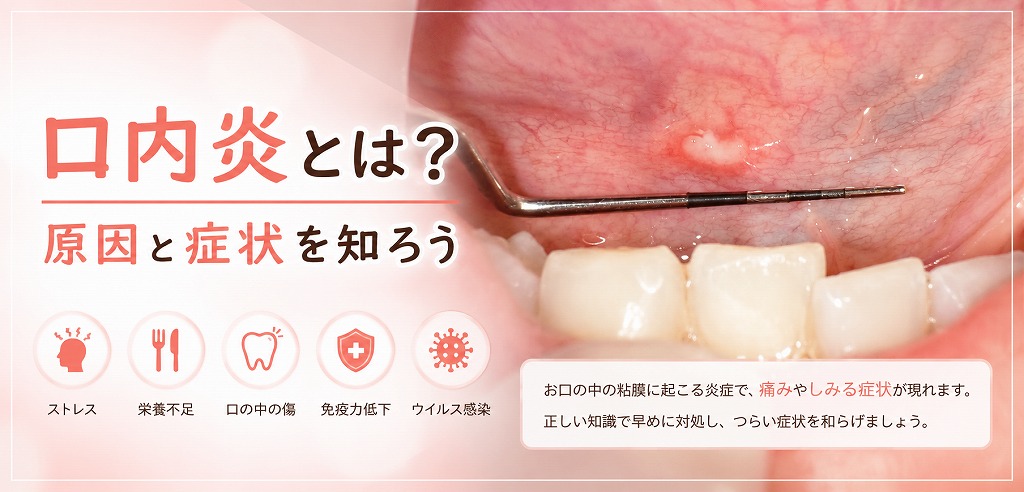 口内炎とは？原因と症状を知ろう