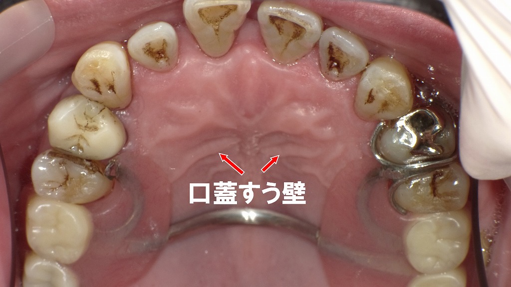 口蓋皺壁（こうがいすうへき）とは