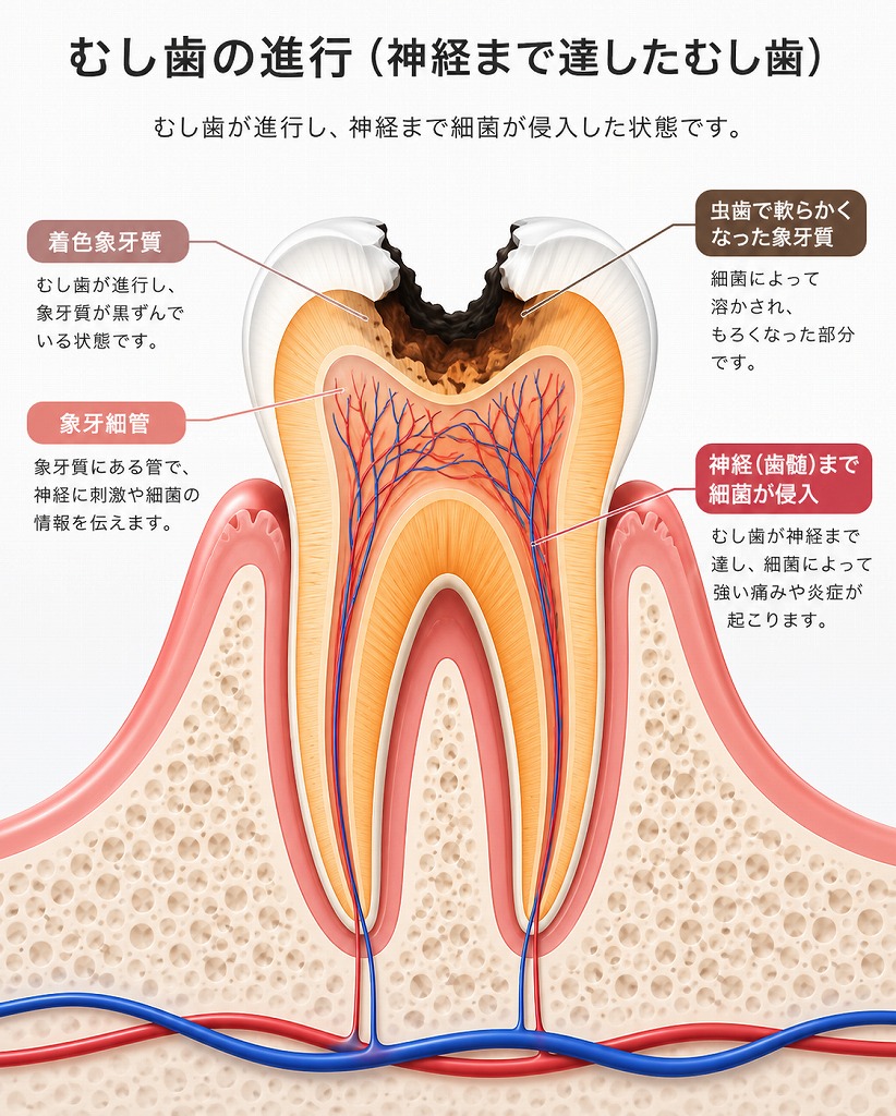 虫歯C3歯髄炎の模式図
