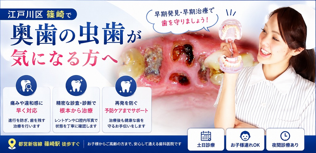 江戸川区篠崎で奥歯の虫歯が気になる方へ
