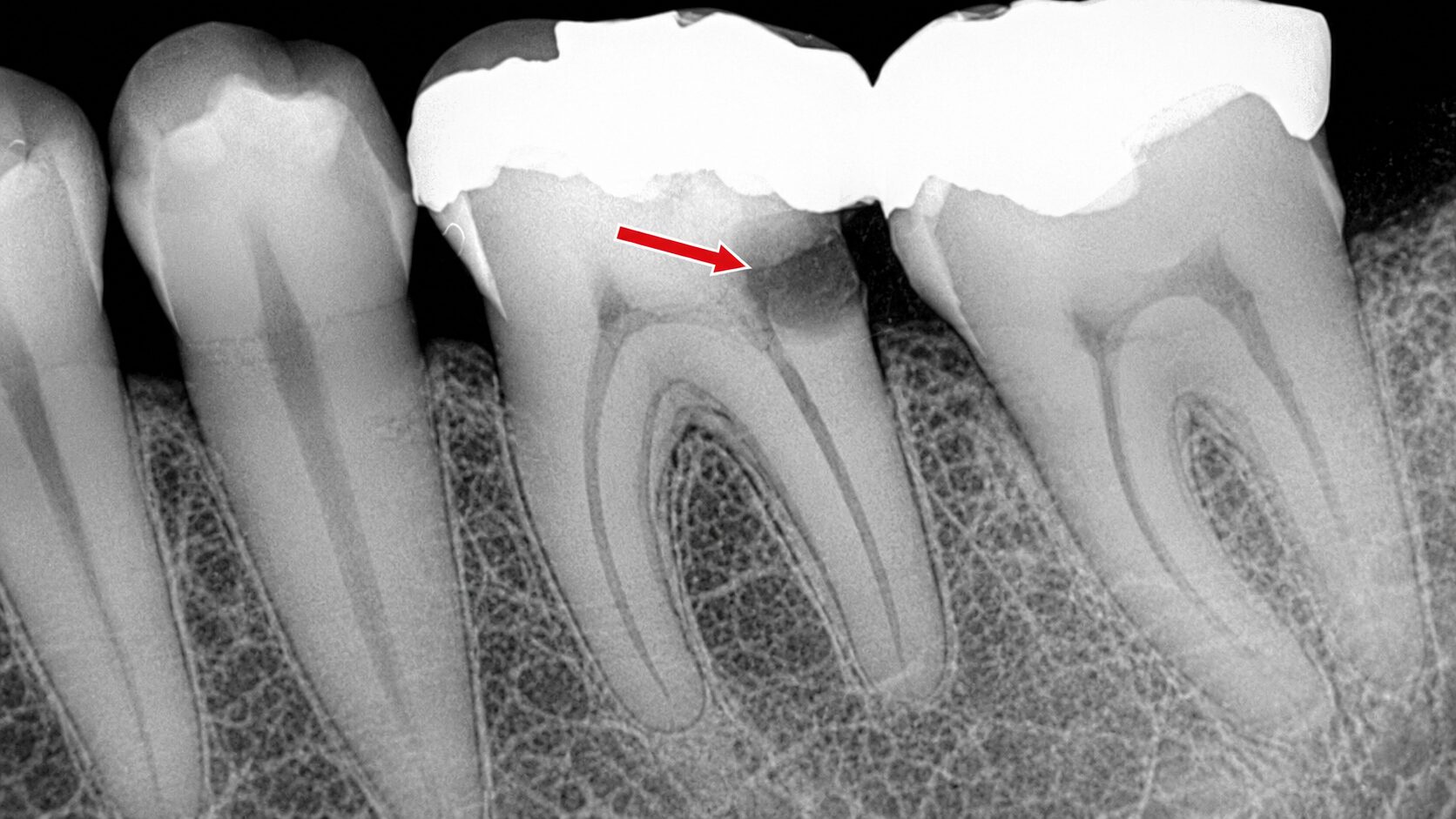 噛むと痛い原因は？奥歯の“見えない虫歯”が神経まで進行