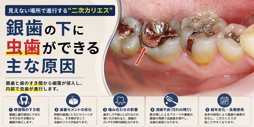 銀歯の下に虫歯ができる主な原因