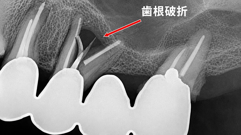 赤矢印の先に見えるのが、縦に割れた5番の歯根。歯根破折は治らないため抜歯が必要です。