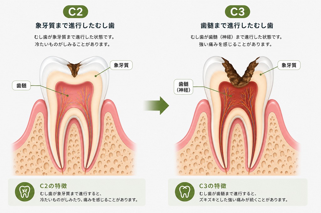 虫歯C2からC3への進行速度