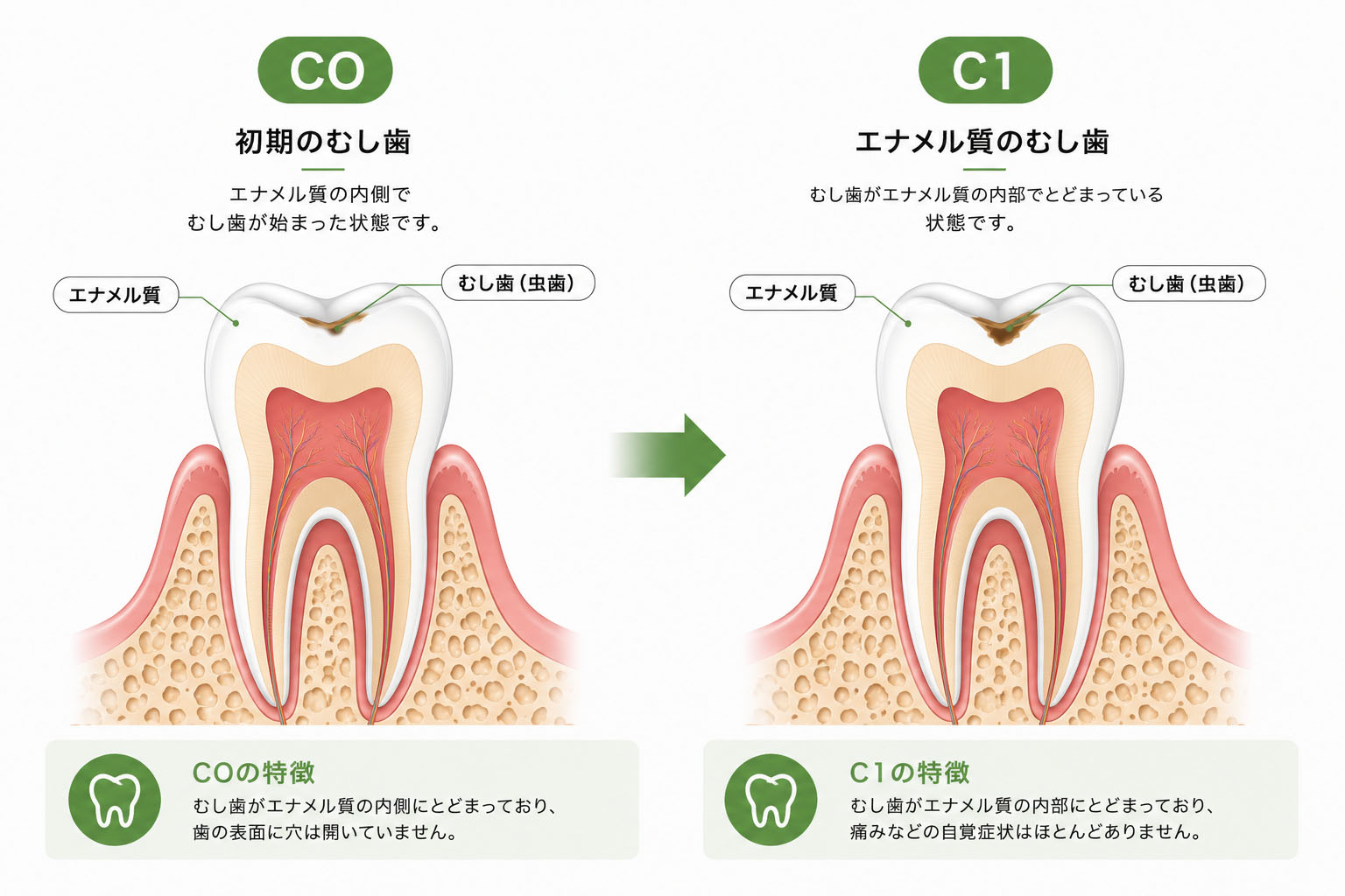 虫歯COからC1への進行速度