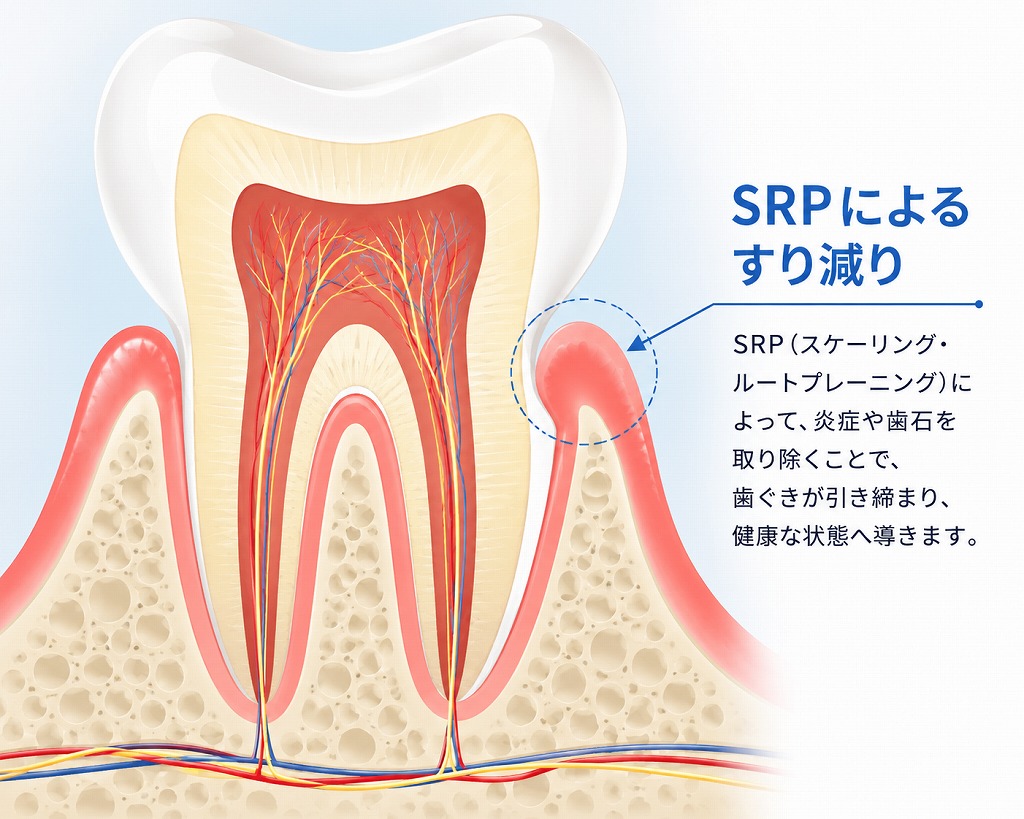 ルートプレーニングの注意点（デメリット）
