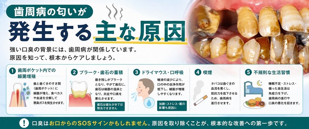 歯周病の匂いが発生する主な原因