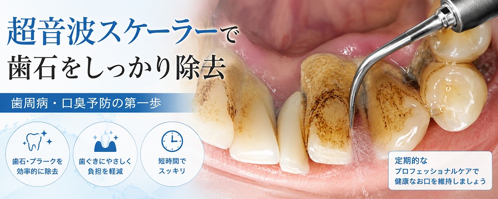 超音波スケーラーで歯石をしっかり除去