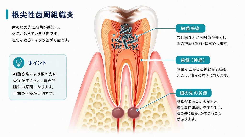 根尖性歯周組織炎：初期の歯根嚢胞